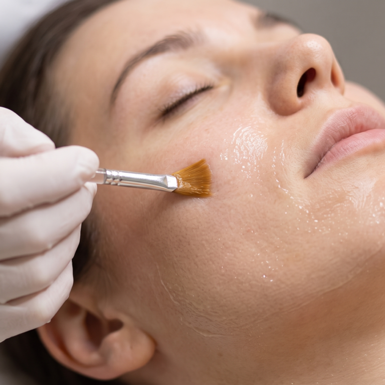 CHEMICAL PEELS