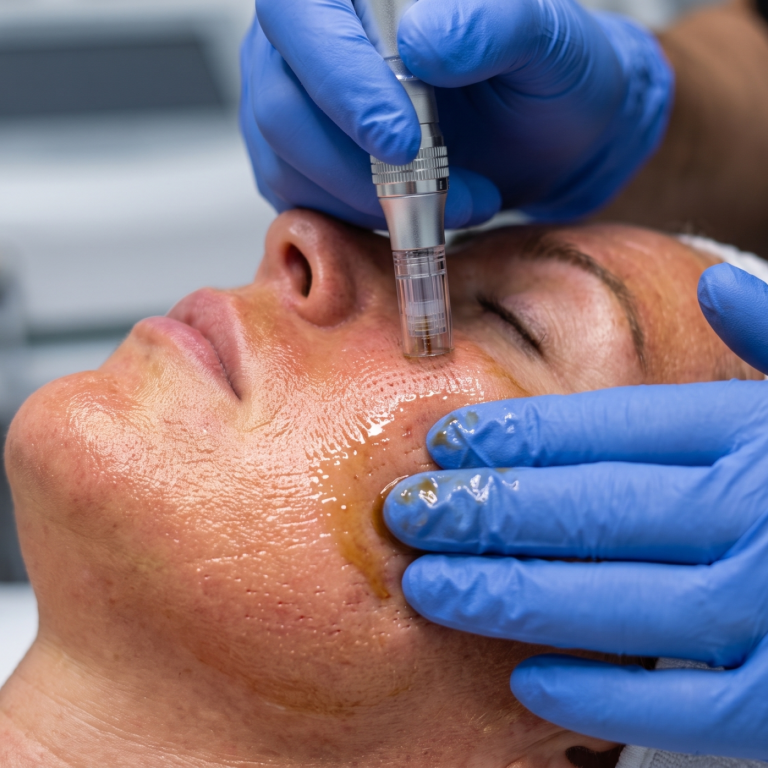 PRP Facial